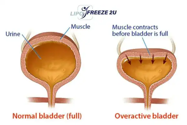 diagram of overactive bladder treatment Merseyside