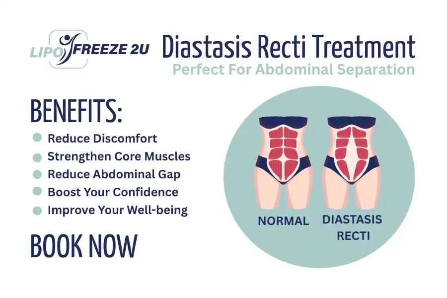 Benefits of body toning treatment Merseyside for Diastasis recti