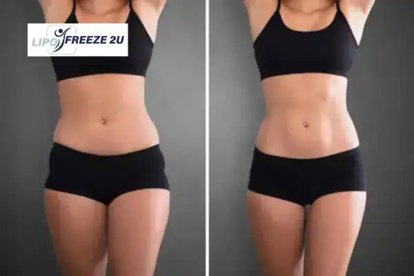 How Can LIPO FREEZE 2U Support Your Post-Pregnancy Body Recovery Merseyside?