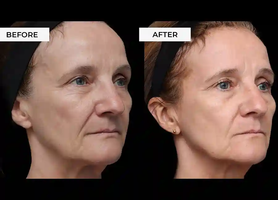 How Many RF Microneedling Sessions Will You Need to See a Difference Merseyside?