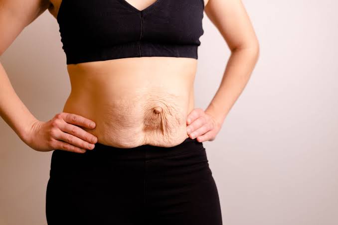Is Surgery Really the Only Way to Repair Diastasis Recti Merseyside?