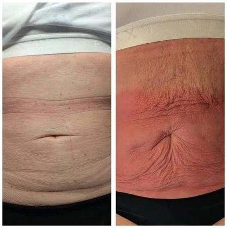 How Does RF Microneedling Improve Crepey, Thin and Uneven Skin Texture Merseyside?