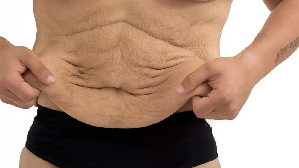 Why Does Weight Loss Medication Leave Some People With Loose or Sagging Skin Merseyside?
